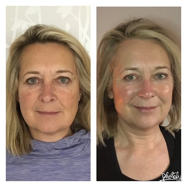 BDB1A587-08ED-4BC9-BED0-240DFCA97996 Zone Face Lift results