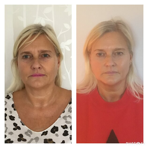 FCD1E9AA-C167-47CB-B35F-6D1F3C497A70 Zone Face Lift results